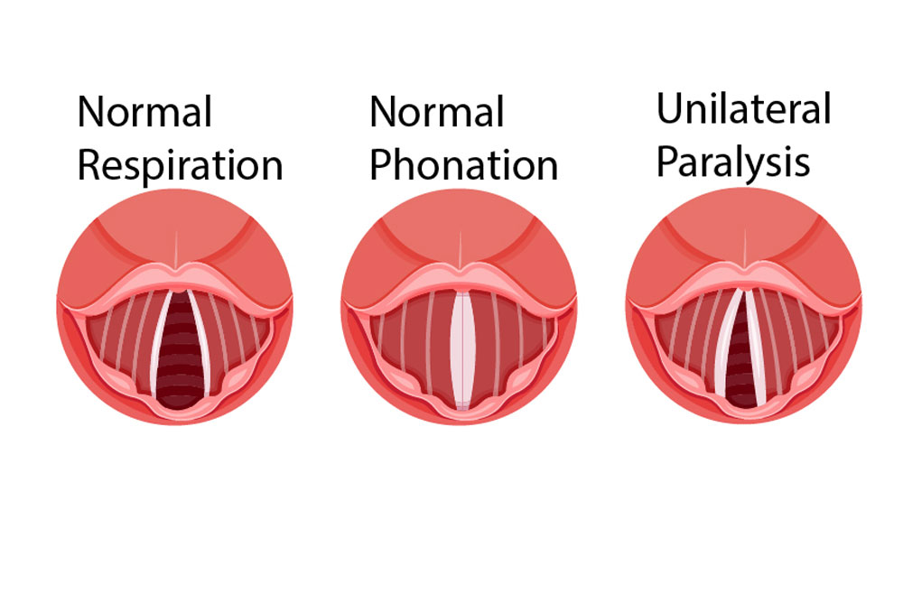 Bilateral Vocal Cord Paralysis